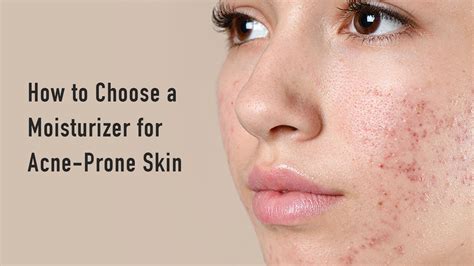 How To Choose A Moisturizer For Acne Prone Skin Savarnasmantra