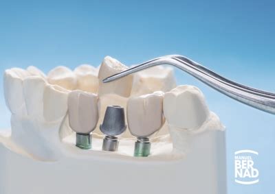 Qué es la prostodoncia y tipos de prótesis dentales Clinica Dental