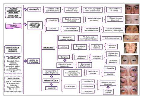 Clasificaci N De La Ptosis Palpebral Iovanny Cruz Ojeda Udocz
