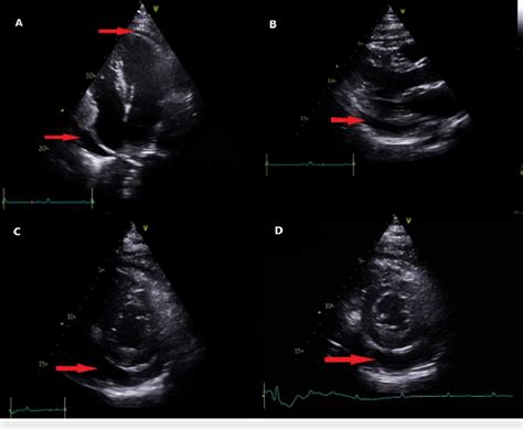 Transthoracic Cardiac Echocardiography Four Chambers View A