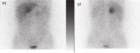 I Mibg Scan Showing Increased Uptake In The Right Adrenal Gland