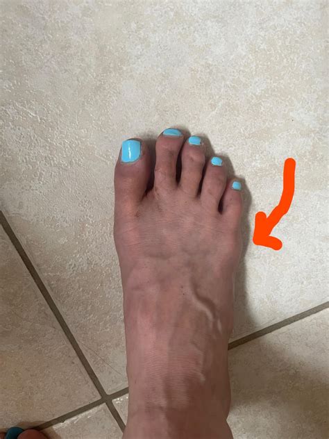Tailors Bunion In A Lot Of Pain Does This Look Bad Enough For Surgery