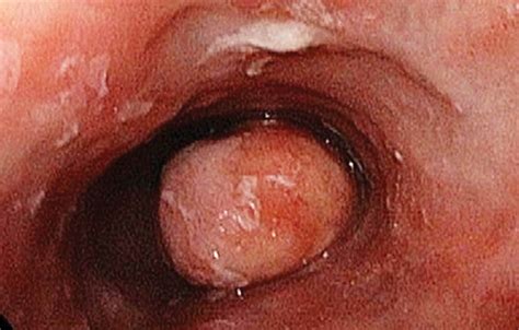 From The Radiologic Pathology Archives Esophageal Neoplasms