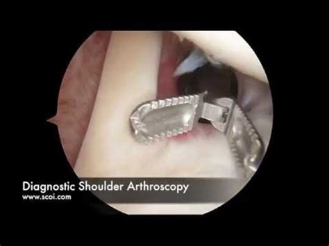 Arthroscopic Shoulder Subacromial Decompression With Distal Clavicle ...