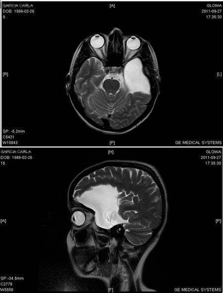 Arachnoid Cysts Physiopedia