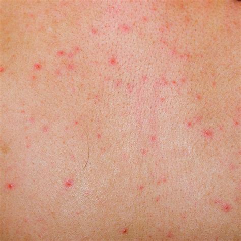 blotchy rash on legs - pictures, photos