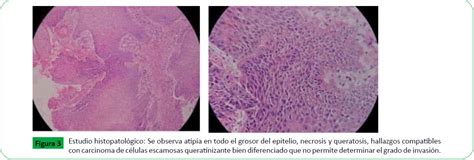 Carcinoma de CÃ Âlulas Escamosas en Conducto Auditivo Extern