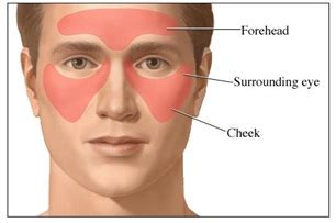 Sinus Headache Causes, Symptoms, Diagnosis and Treatment | Natural Health News