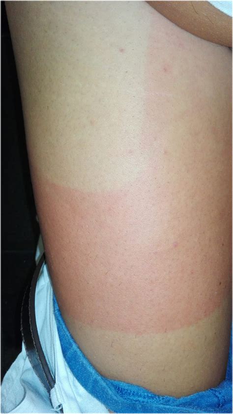 An Unusual Case Of Solar Urticaria Exacerbated By Clothing