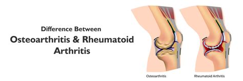 Artrosis Y Artritis Reumatoide Diferencias Clave Y Tratamientos