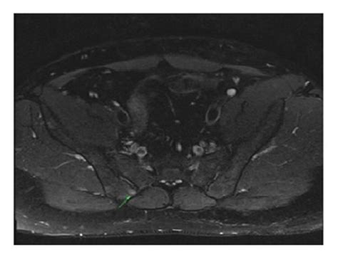 Sacroiliac Joint Magnetic Resonance Imaging Was Consistent With Download Scientific Diagram