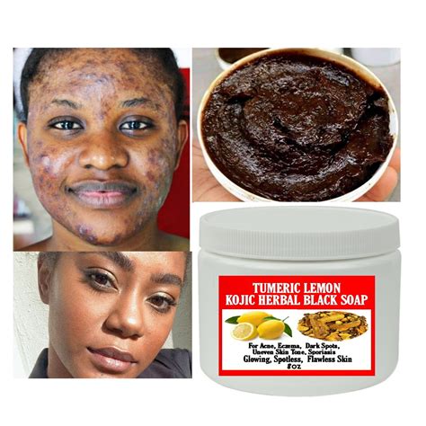 African Soap For Acne