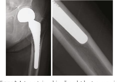 Figure 1 From Two Cases Of Periprosthetic Atypical Femoral Fractures In Patients On Long Term