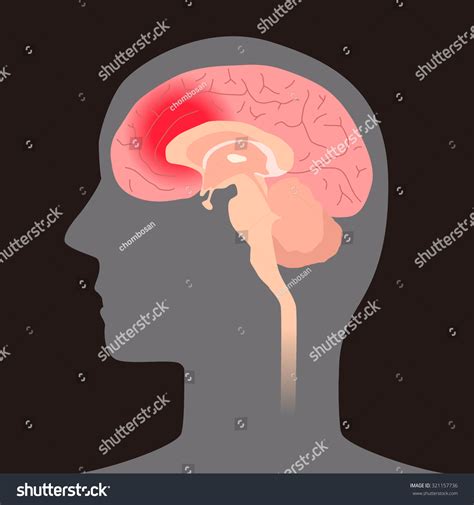 Cerebral Hemorrhage Concept Illustration Royalty Free Stock Vector