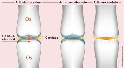 Arthrose Un Nouvel Implant Pourrait R G N Rer L Articulation Ab M E