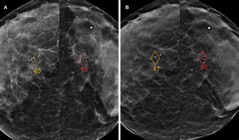 Stand Alone Use Of Artificial Intelligence For Digital Mammography And