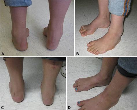 Orthopaedic Management Of Spina Bifida—part Ii Foot And Ankle