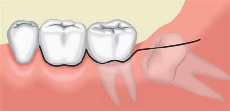 Flap Design in Dento-alveolar Surgery | LaptrinhX / News