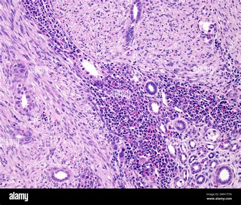 Congenital Mesoblastic Nephroma Light Micrograph Stock Photo Alamy