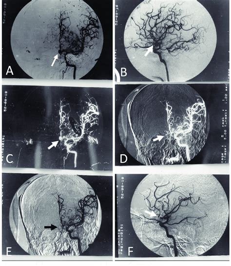 A 46 Year Old Woman With A Ruptured Anterior Communicating Artery