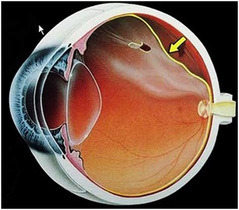 Cl Nica De Ojos Nahui Desprendimiento De Retina