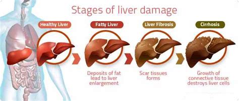 Liver Transplant : What should You Know - Indo 2 Africa Medical Tourism ...