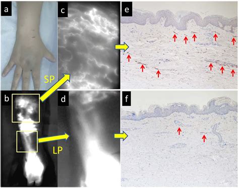 Figure From Indocyanine Green Icg Lymphography Is Superior To