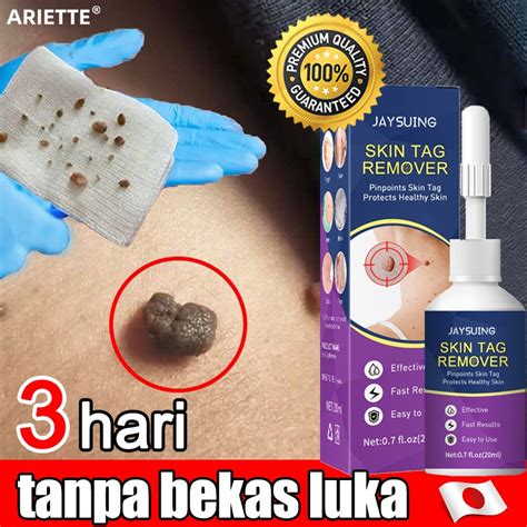 Jual Penghilang Kutil Alami Wart Remover Untuk Menghilangkan Kutil Di