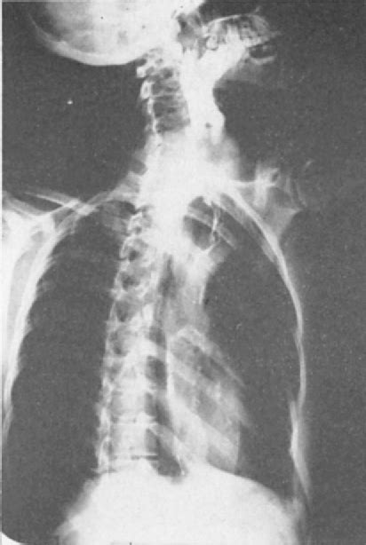 Figure 12 from Surgery of the esophagus. | Semantic Scholar