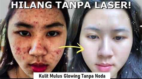 3 Serum Untuk Mengecilkan Pori Pori Dan Menghilangkan Bekas Jerawat