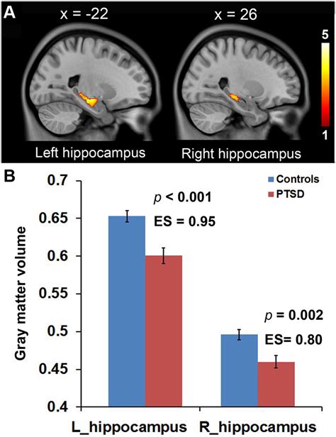 Reduced Gray Matter Volumes Of The Bilateral Hippocampi In Ptsd