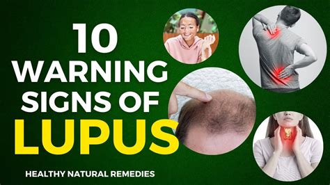 10 Warning Signs Of Lupus Youtube