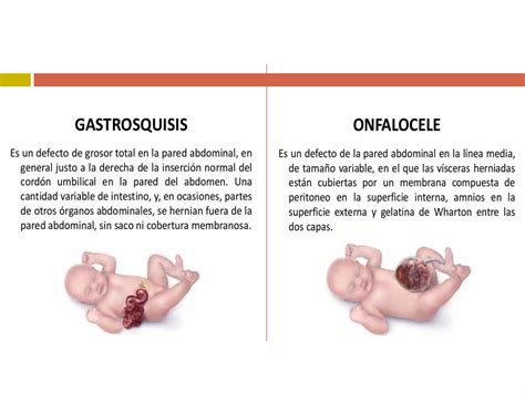 Gastrosquisis Y Onfalocele Ppt