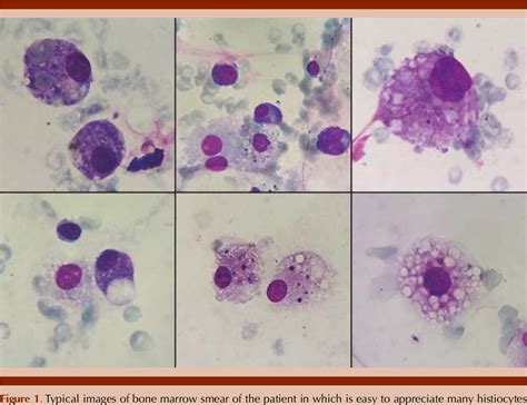 Figure 1 From Hemophagocytic Lymphohistiocytosis In A Patient With