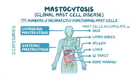 Mastocytosis Nord Video Anatomy And Definition Osmosis