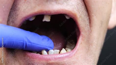 Video Stock The Man Has Rotten Teeth Teeth Fell Out Yellow And Black