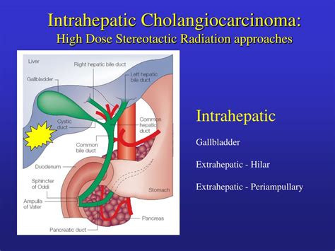 PPT - The Role of Radiation therapy for Intra- and Extrahepatic Biliary Cancers PowerPoint ...