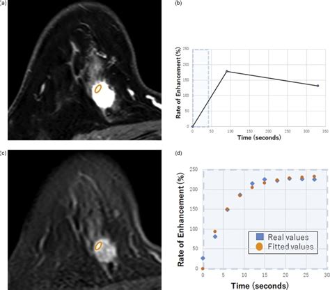 Ultrafast Dynamic Contrast Enhanced Breast Mri Kinetic Curve