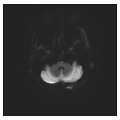 Magnet Resonance Imaging Axial T2 Weighted Images Showing Increased