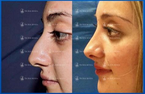 Rinoplastia Caso S Ntomas Posteriores Mas D Ti Facial