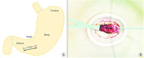 A Gastric Incision After Inserting First Wound Retractor B Pulling