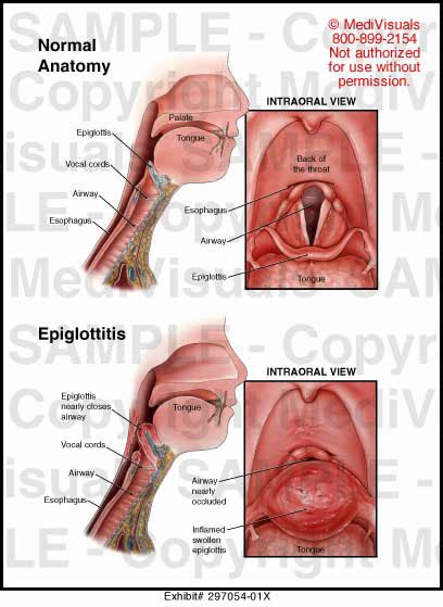 Epiglottitis Medical Illustration Medivisuals