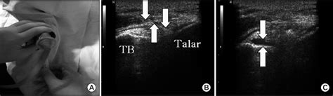 A Sono Guided Intraarticular Injection B Before Sono Guided