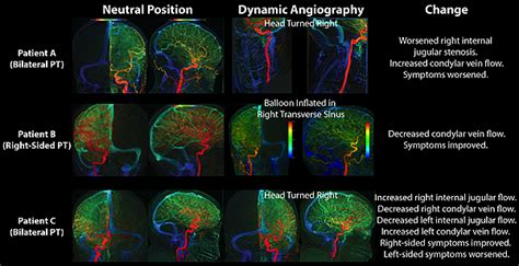 Pulsatile Tinnitus Causes And Treatments Ucsf Radiology