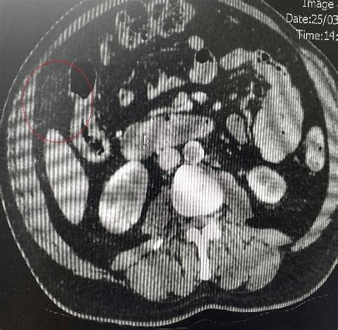 Omental Infarction A Case Treated With Laparoscopic Surgery