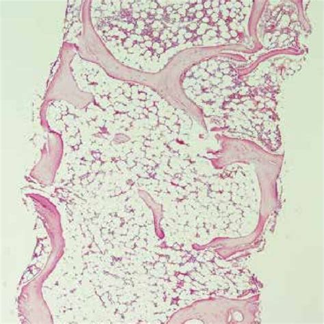 Bone Marrow Trephine Biopsy Section Aplastic Anemia Showed Marked