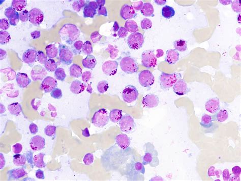 Infiltration Of Neoplastic Lymphocytes In The Spleen Cytology Staining Download Scientific