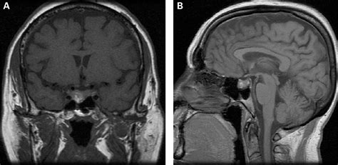 Cavernous Sinus Mri