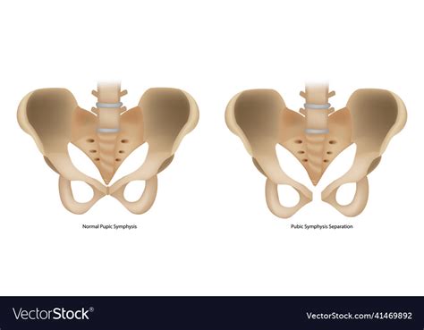 Pubic Symphysis Separation Or Spd Pubis Royalty Free Vector