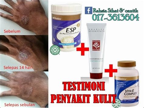 Atasi Penyakit Gatal Kulit Kurap Dan Eczema Dengan Produk Shaklee